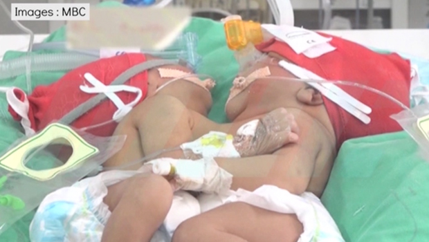 Des sœurs siamoises bientôt séparées en île Maurice