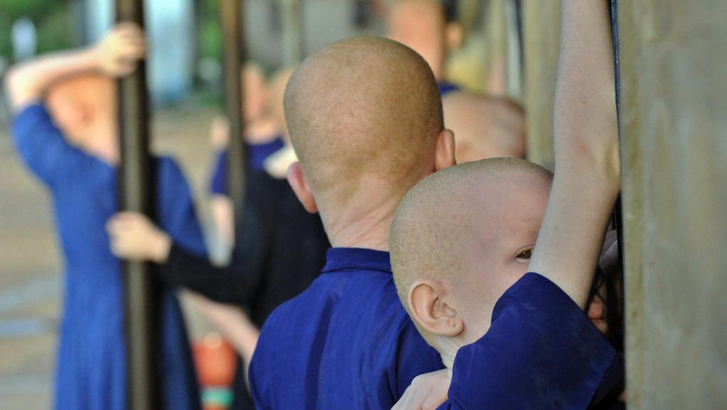 Burundi: le corps d’un jeune albinos retrouvé démembré