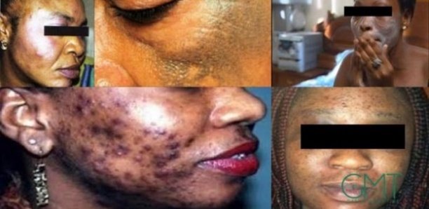 ​Publicité sur la dépigmentation ou « Xessal » : le Cnra met en demeure Tfm, Sen Tv et Zik Fm