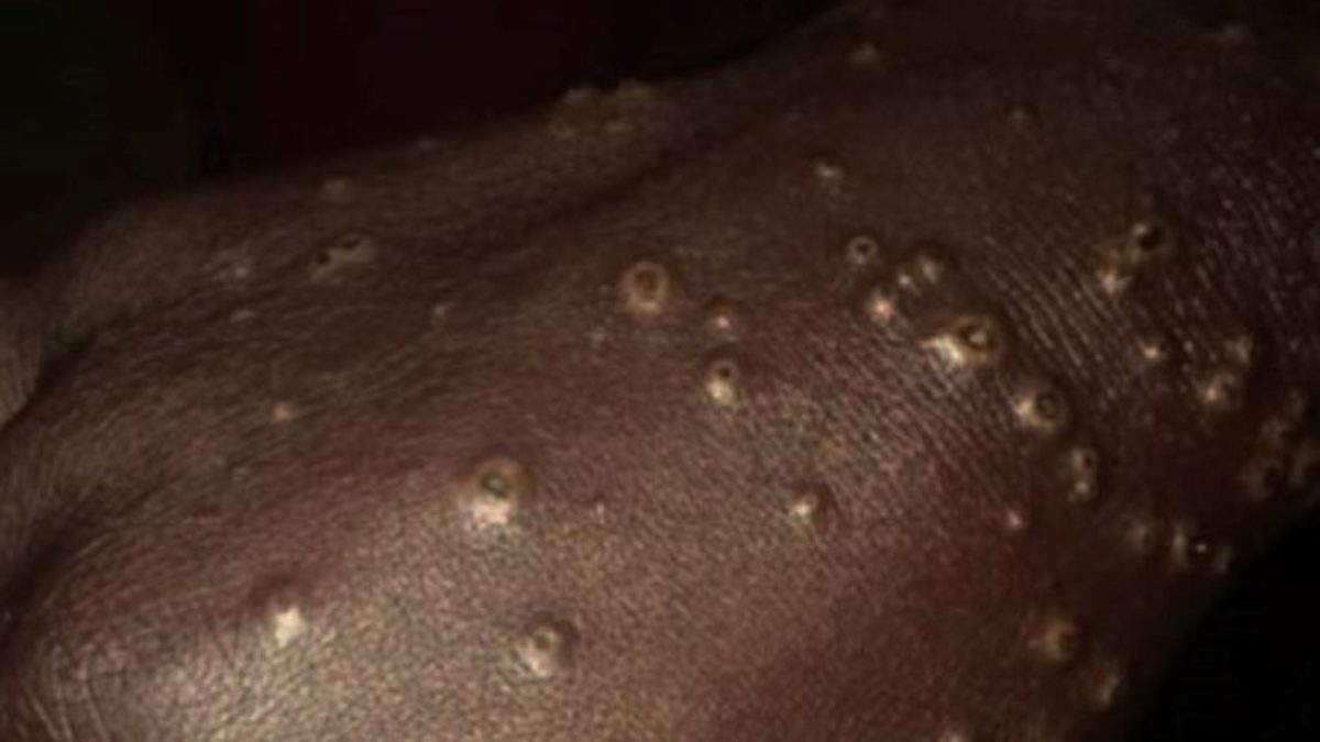 Maladie dermique détectée chez des pêcheurs : la région de Thiès touchée et comptabilise 260 cas