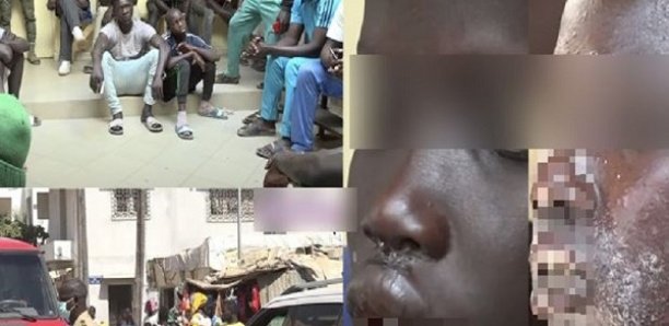 Dermatoses des pêcheurs: la cause infectieuse exclue 