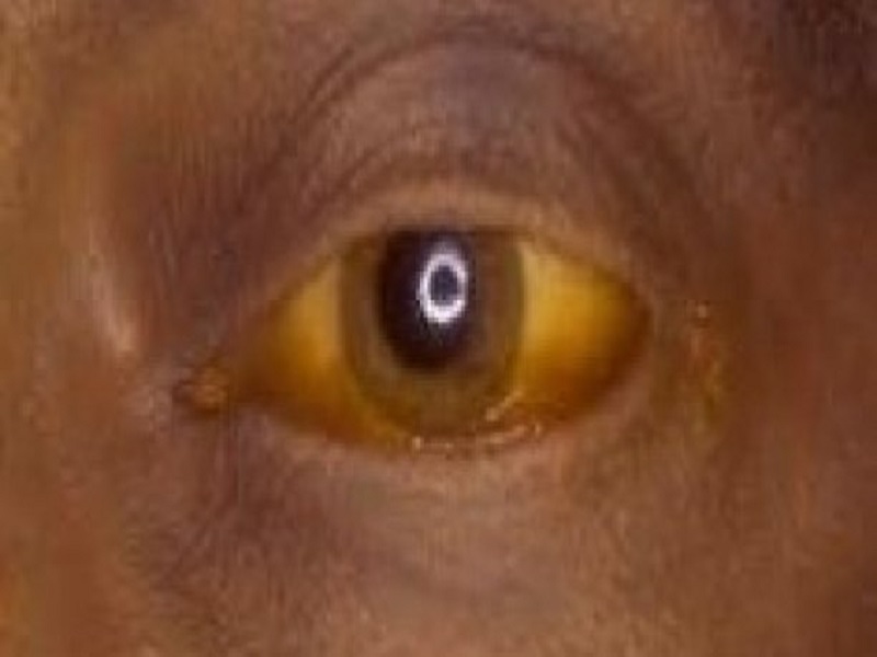 Tambacounda: 4 cas de Fièvre jaune détectés, 2 morts annoncés