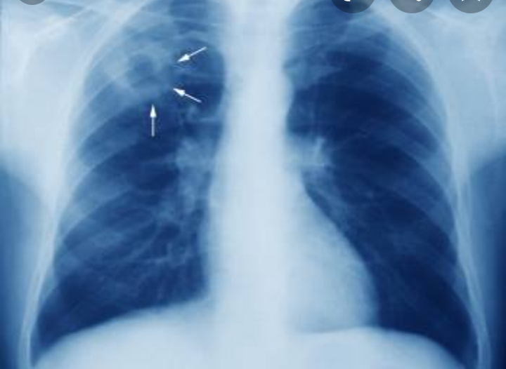 Tuberculose : 1,4 million de malades privés des soins nécessaires pendant la première année de la Covid-19 (OMS)