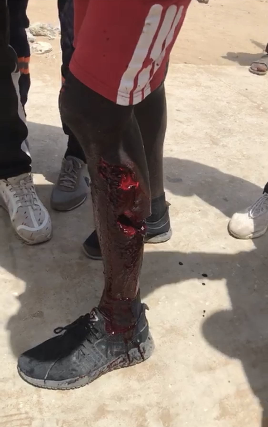 Un étudiant grièvement blessé à l’Ucad: son mollet partiellement emporté par une grenade lacrymogène