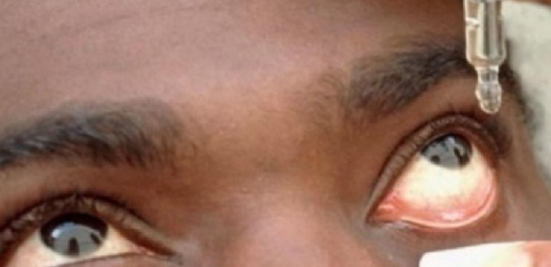 La forme de conjonctivité notée actuellement peut être due à un virus (ophtalmologiste)