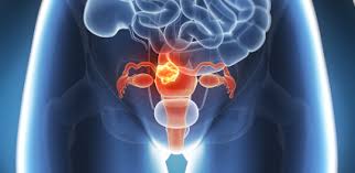 Cancer du col de l’utérus : plus de 11.317 cas sont enregistrés au Sénégal chaque année