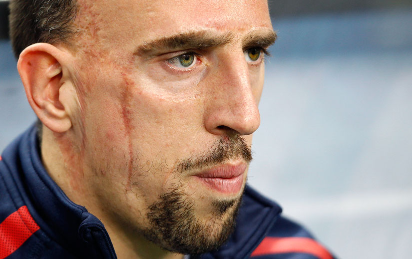 Franck Ribéry : opéré d'un hématome aux fessiers
