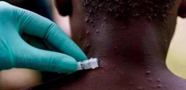 Variole du singe : 1.500 cas suspects, 600 cas confirmés et 72 décès recensés dans 39 pays
