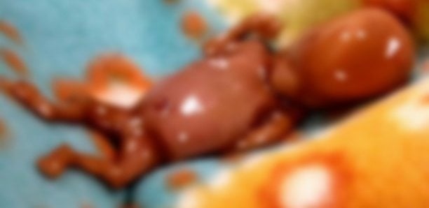 Golf Sud : Un sachet contenant un fœtus et du matériel médical trouvé devant un immeuble