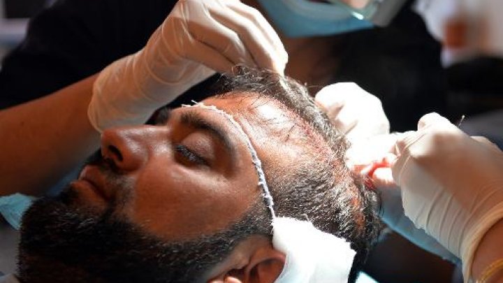 Pakistan: la greffe de cheveux, nouvelle arme de séduction massive