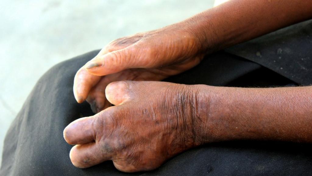 Madagascar: 1600 nouveaux cas de lèpre recensés chaque année