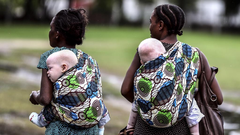 En Tanzanie, les albinos sont souvent victimes d'enlèvements à des fins de sorcellerie, à Dar-es-Salam, le 5 mai 2014.