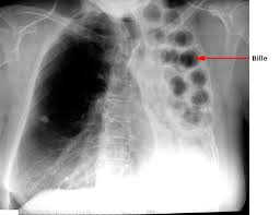 Journée mondiale de lutte contre la tuberculose:  « Atteindre les manquants »