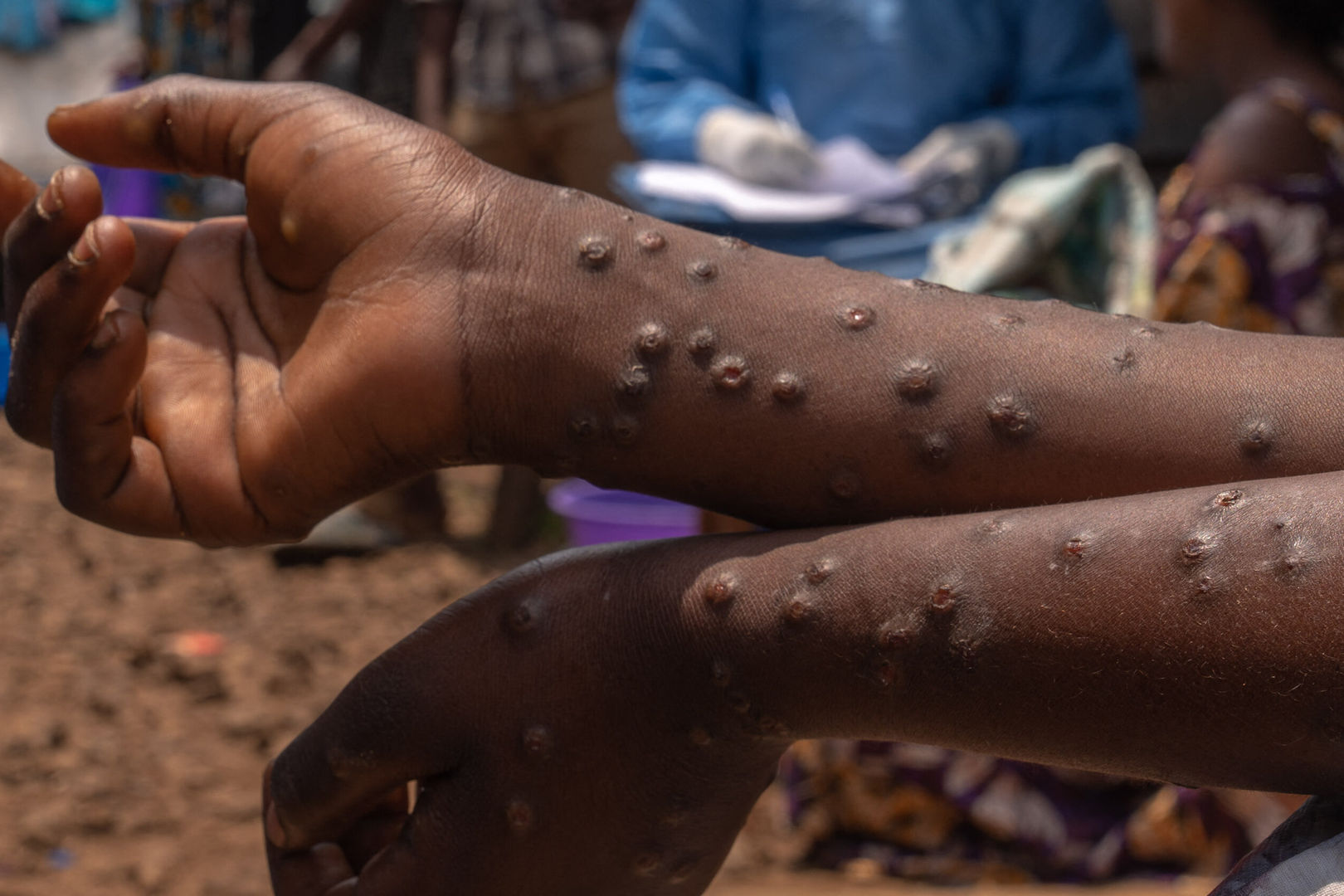 Mpox : deux nouveaux cas confirmés au Sénégal, 42 contacts suivis