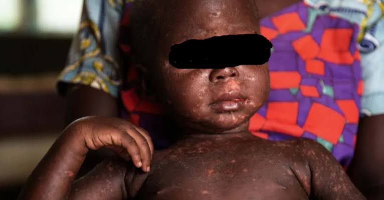 Kédougou : 22 cas positifs de rougeole enregistrés sur 36 cas suspects