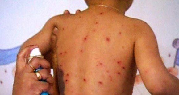 Kédougou : sept cas de rougeole confirmés dans le district sanitaire de Saraya 