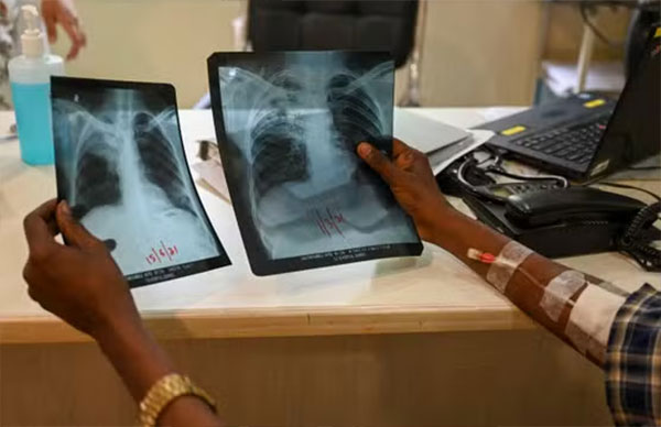 Foundiougne : cinq cas de tuberculose enregistrés en 2026 dont un décès