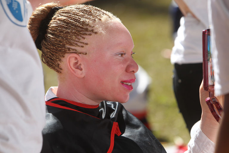 À Madagascar, une série d’attaques contre des personnes albinos ravive la peur