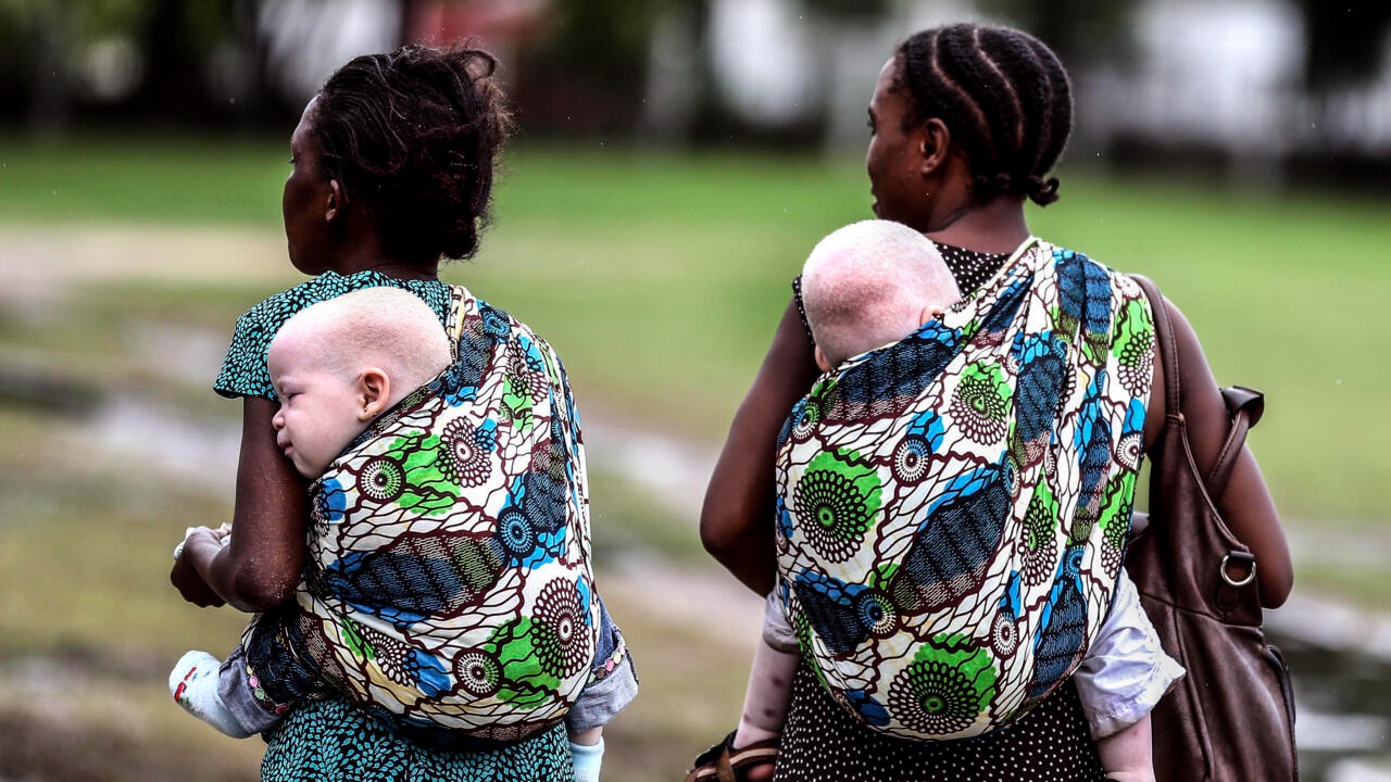 Thiès : les albinos du Sénégal inaugurent la première usine de crème solaire d’Afrique de l’Ouest Thiès : les albinos du Sénégal inaugurent la première usine de crème solaire d’Afrique de l’Ouest