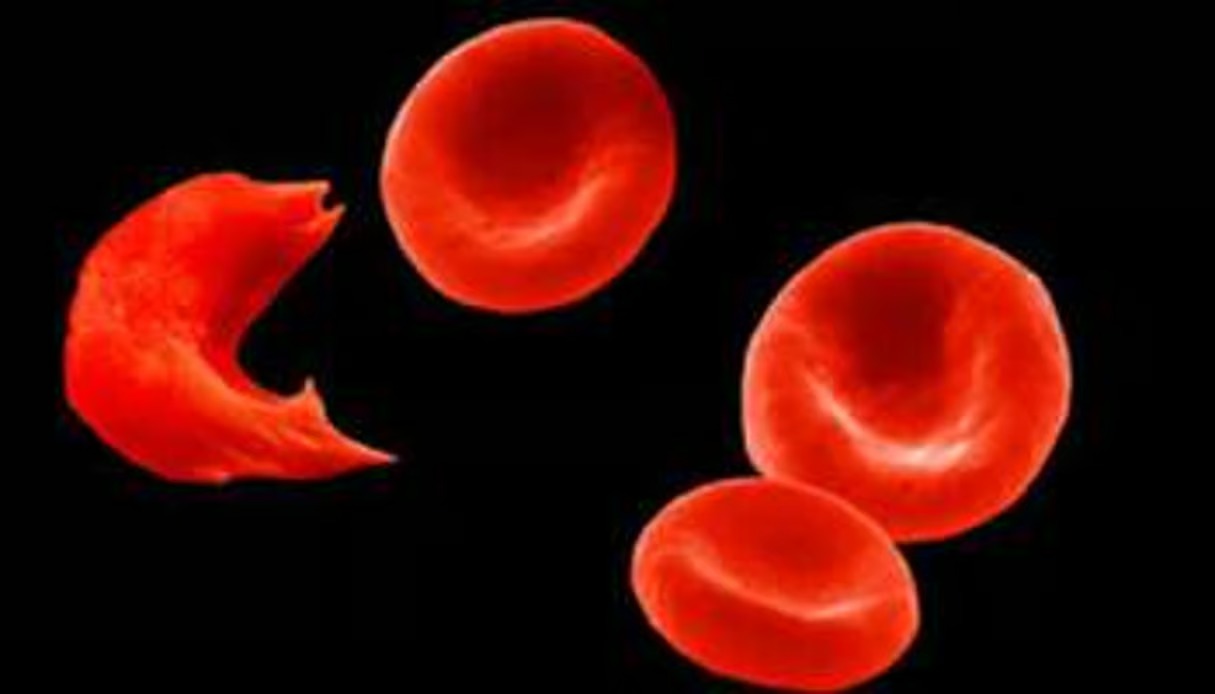 « 80 % des enfants atteints meurent avant 5 ans » : le cri d'alarme de l'Africa CDC face à la drépanocytose
