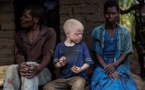 Mozambique : «Les personnes albinos sont pourchassées»