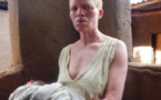 Malawi : les Albinos témoignent : « J’ai tellement peur que je ne dors plus. »
