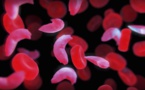 Drépanocytose : première guérison par thérapie génique