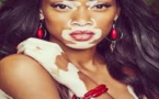 Atteinte de vitiligo, elle fait sensation sur le tapis rouge