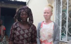 En Gambie, la sensibilisation à la cause des albinos porte ses fruits