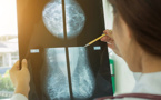 ​Un logiciel calcule pour chaque femme le risque de cancer du sein