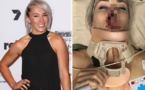 La championne du monde de BMX Caroline Buchanan fait un grave accident