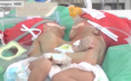 Des sœurs siamoises bientôt séparées en île Maurice