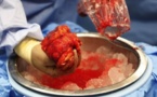Kosovo: cinq médecins condamnés dans une affaire de trafic international d'organes