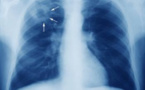 Tuberculose : 1,4 million de malades privés des soins nécessaires pendant la première année de la Covid-19 (OMS)