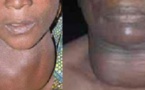 L’Association sénégalaise des malades de la thyroïde plaide pour un diagnostic précoce de la maladie