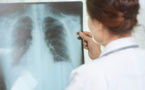 Tuberculose : La Covid-19 a provoqué une augmentation des décès pour la première fois en 10 ans