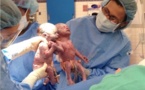 La photo cute : Des jumelles naissent en se tenant la main