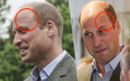 D’où vient cette étrange cicatrice sur le front du prince William?