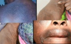 « La dépigmentation peut causer le diabète, l’hypertension artérielle ou l’insuffisance rénale » (Pr Fatoumata Ly)