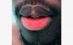 Dépigmentation des parties intimes aux baumes "lèvres roses": un phénomène inquiétant au Sénégal