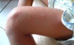 Kédougou : Des cas de «Chikungunya» décelés