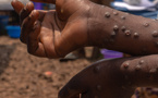 Sénégal : un nouveau cas de Mpox enregistré (Ministère)