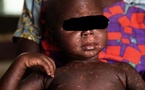 Kédougou : 22 cas positifs de rougeole enregistrés sur 36 cas suspects
