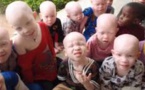 La chasse aux albinos s’intensifie au Malawi