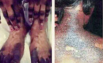 Santé publique : le Dr Ibrahima Ndiaye dénonce les effets dévastateurs de la dépigmentation artificielle