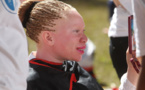 ​Albinos de tous les pays d’Afrique, unissez-vous !