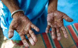 ​Thiès : aucun nouveau cas de lèpre recensé en 2026, après les sept enregistrés en 2025