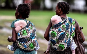 ​Thiès : les albinos du Sénégal inaugurent la première usine de crème solaire d’Afrique de l’Ouest