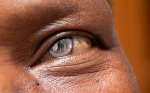 Cataracte et maladies oculaires : 481 opérations gratuites lancées à Yeumbeul