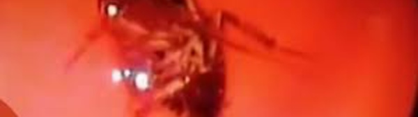 ​ Vidéo : un cafard vivant retrouvé dans le crâne d'une Indienne